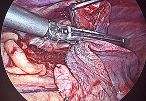 VATS-Thoracoscopic Surgery-Staple Application by Dr Avinash Dal